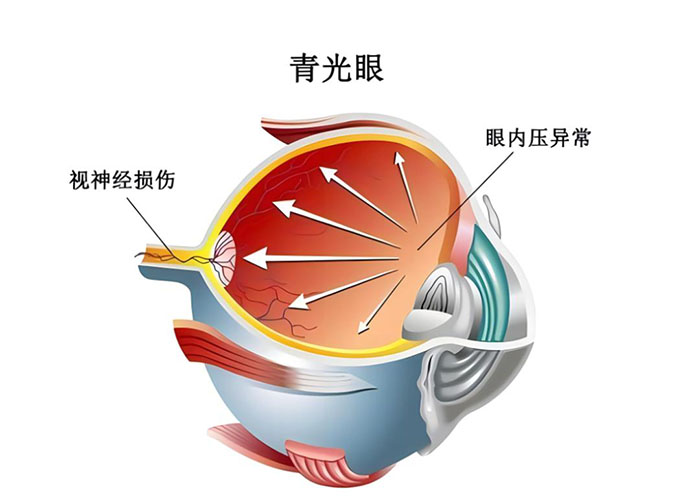 青光眼.jpg